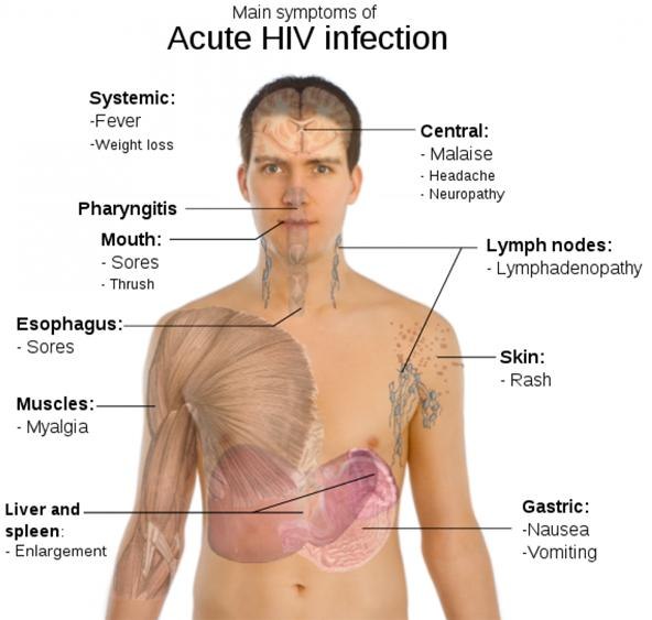 HIV Aids symptoms
